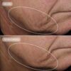 Volulift_BeforeAndAfter_subject_1 VOL.U.LIFT™ 4D SKIN REBOUND COMPLEX