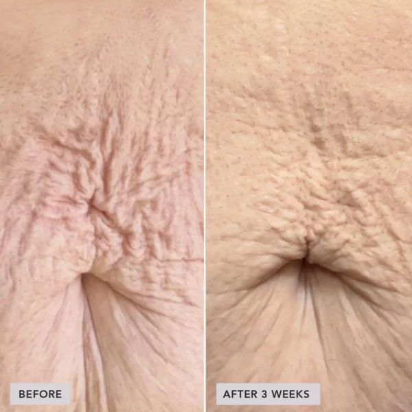 imageskincare-volulift-body-before-after2.jpg VOL.U.LIFT™ BODY nostiprinošs ķermeņa krēms